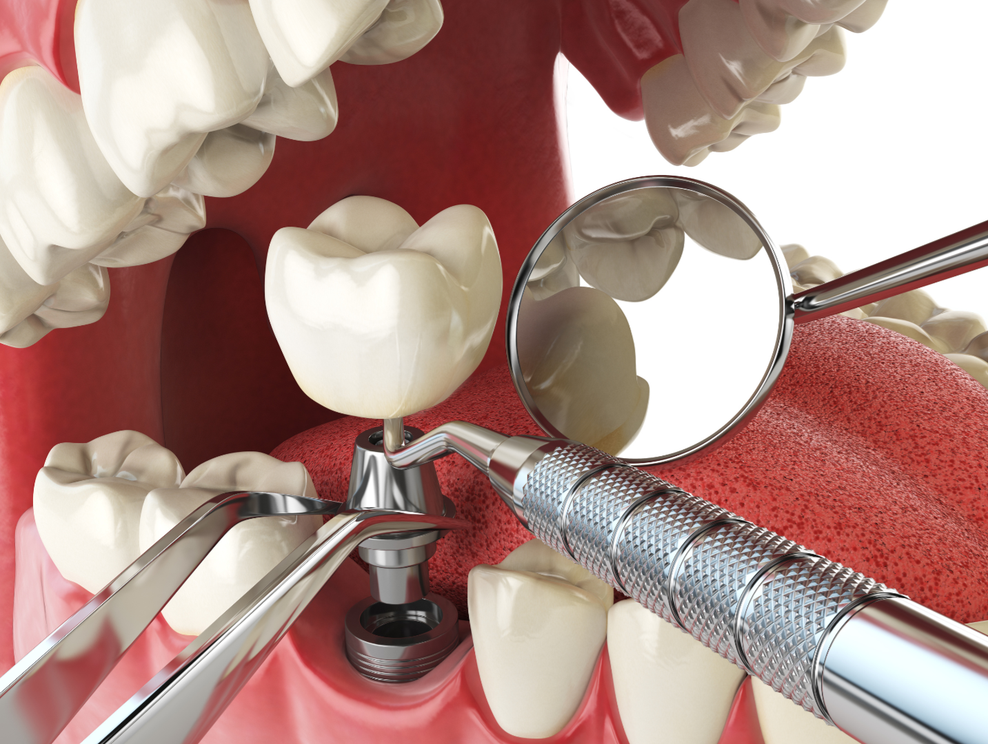Teeth Implants