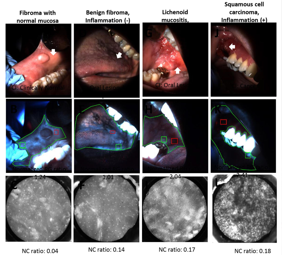 A microendoscopic evaluation of an oral mucosal lesion.