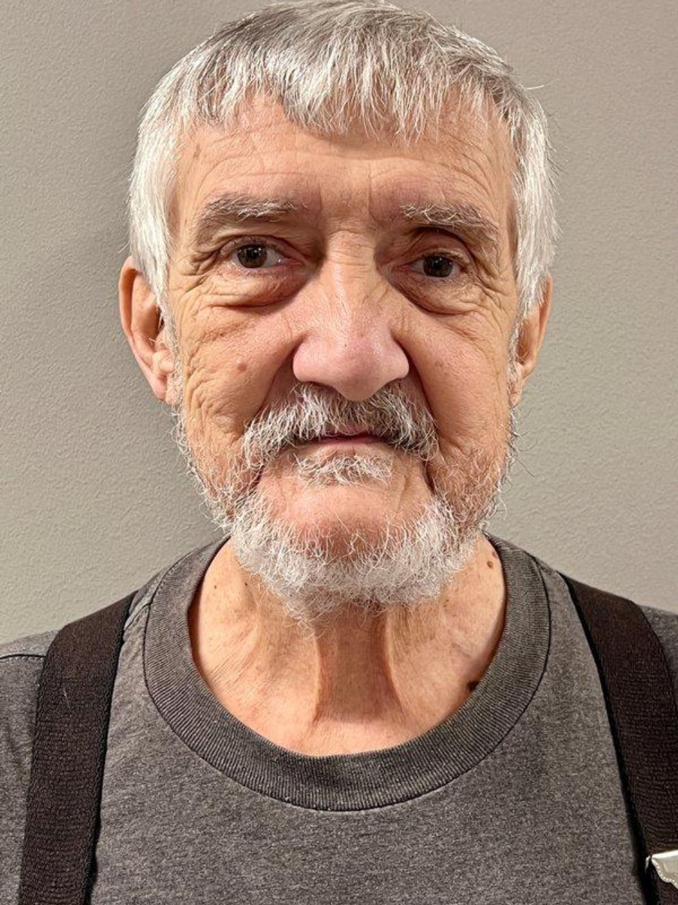 William Baker, 72, shows his healing progress at his September post-operative appointment. William Baker, 72, shows his healing progress at his September post-operative appointment.