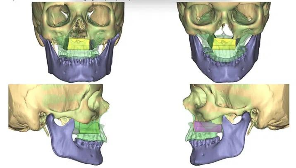 The reconstruction of Sue’s upper jaw required a transplant of bone, skin, and blood vessels from her lower leg, known as a free tissue transfer or free flap.